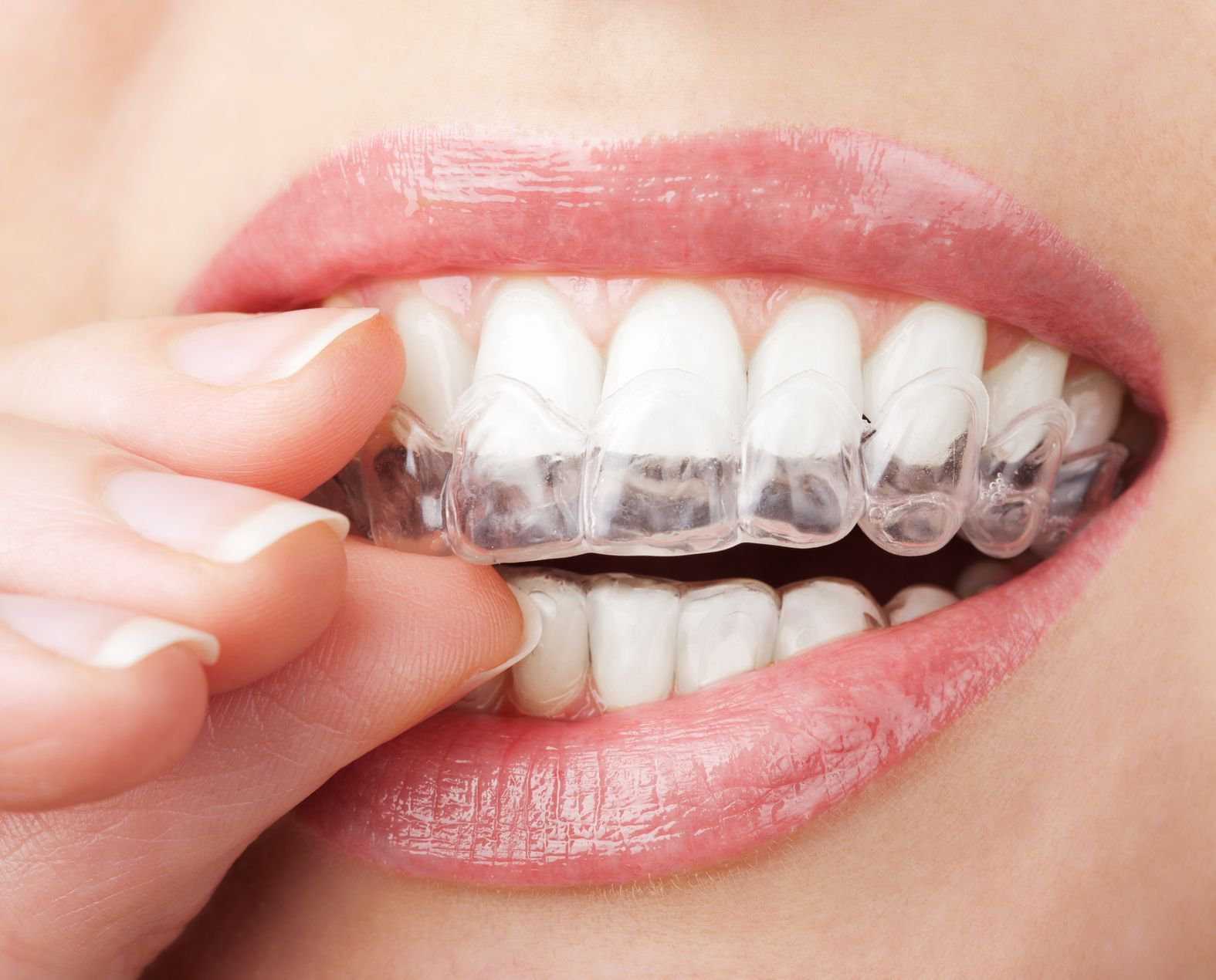 Tìm hiểu về phương pháp niềng răng trong suốt chỉnh nha là gì?