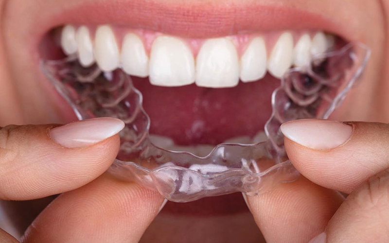 Niềng răng trong suốt giúp kiểm soát được sự dịch chuyển của răng hiệu quả