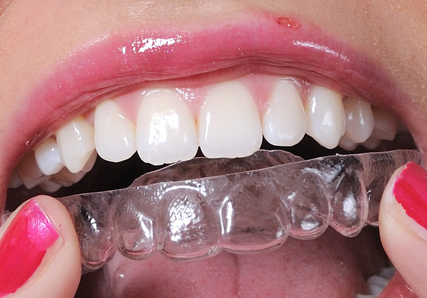 Niềng răng trong suốt chỉ nên áp dụng cho những tình trạng răng lệch lạc, khấp khểnh nhẹ để đạt được hiệu quả tối ưu nhất